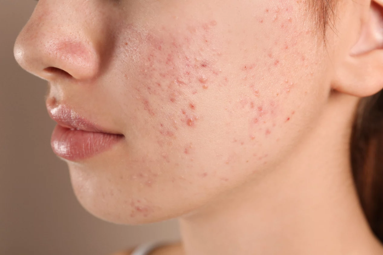 o que causa acne